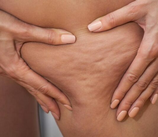 Following These Steps, You Can Get Rid Of Stubborn Fat And Cellulite Stubborn Fat And Cellulite