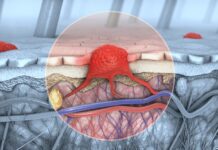 Understanding Basal Cell Carcinoma Before Consulting A Chevy Chase Doctor Basal Cell Carcinoma