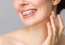 Traditional Braces Vs Invisalign For Teeth Straightening Braces