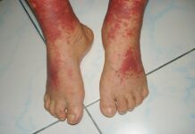 What is Vasculitis? Symptoms, Causes, & Treatment Vasculitis