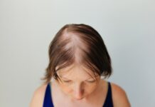 Understanding Alopecia Areata: Causes, Prevention, and Management Alopecia Areata